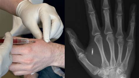 countries putting rfid chips in their people|rfid chip implants.